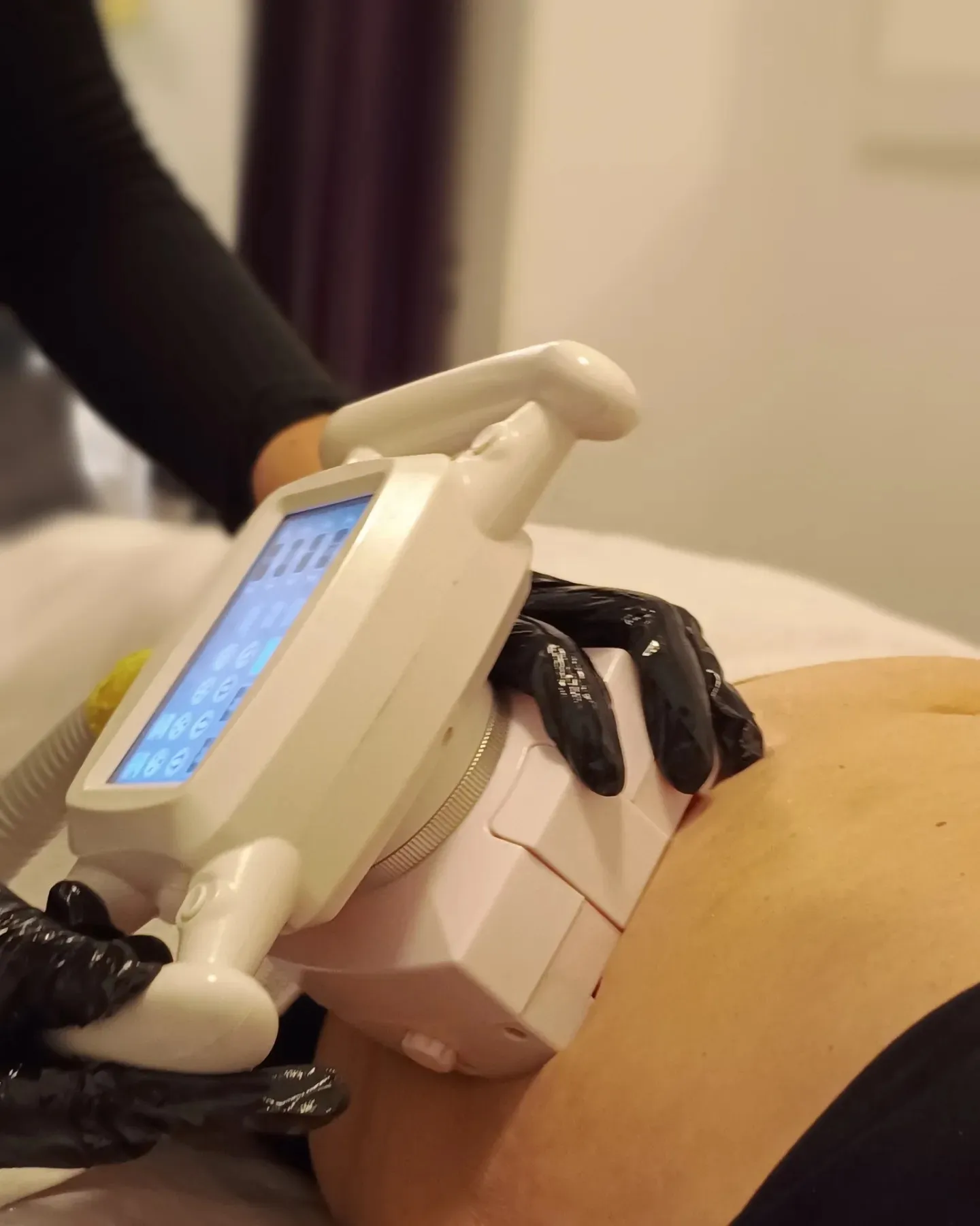 Uređaj Cryo Lipo na trbuhu